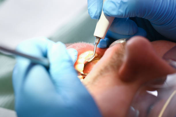 Best Emergency Wisdom Teeth Removal in Fairland, MD