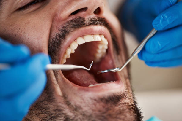 Best Emergency Tooth Extraction in Fairland, MD